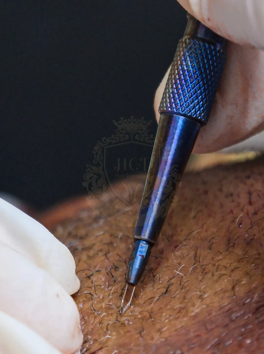 transplante capilar fue safira turquia hair center of turkey clínica