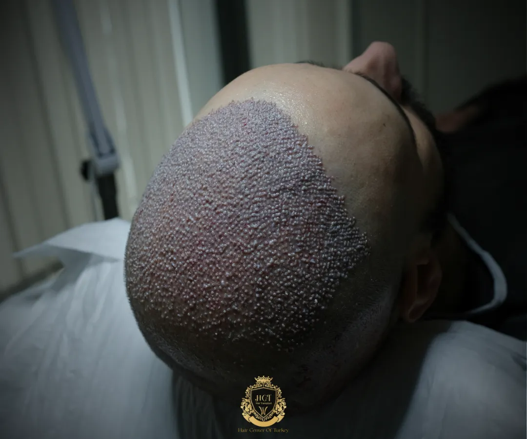 hair transplant key cost factors