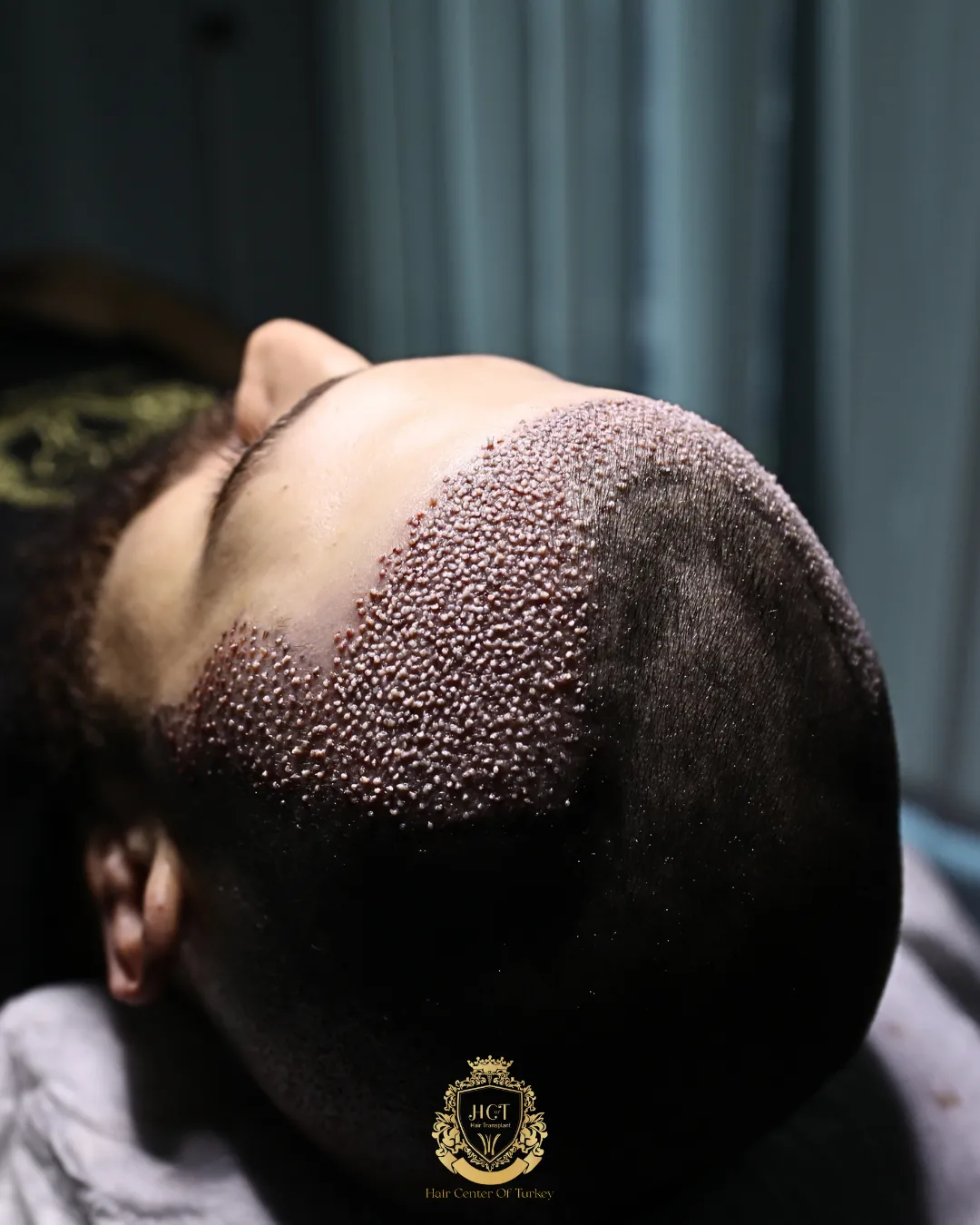 why choose turkey for a hair transplant