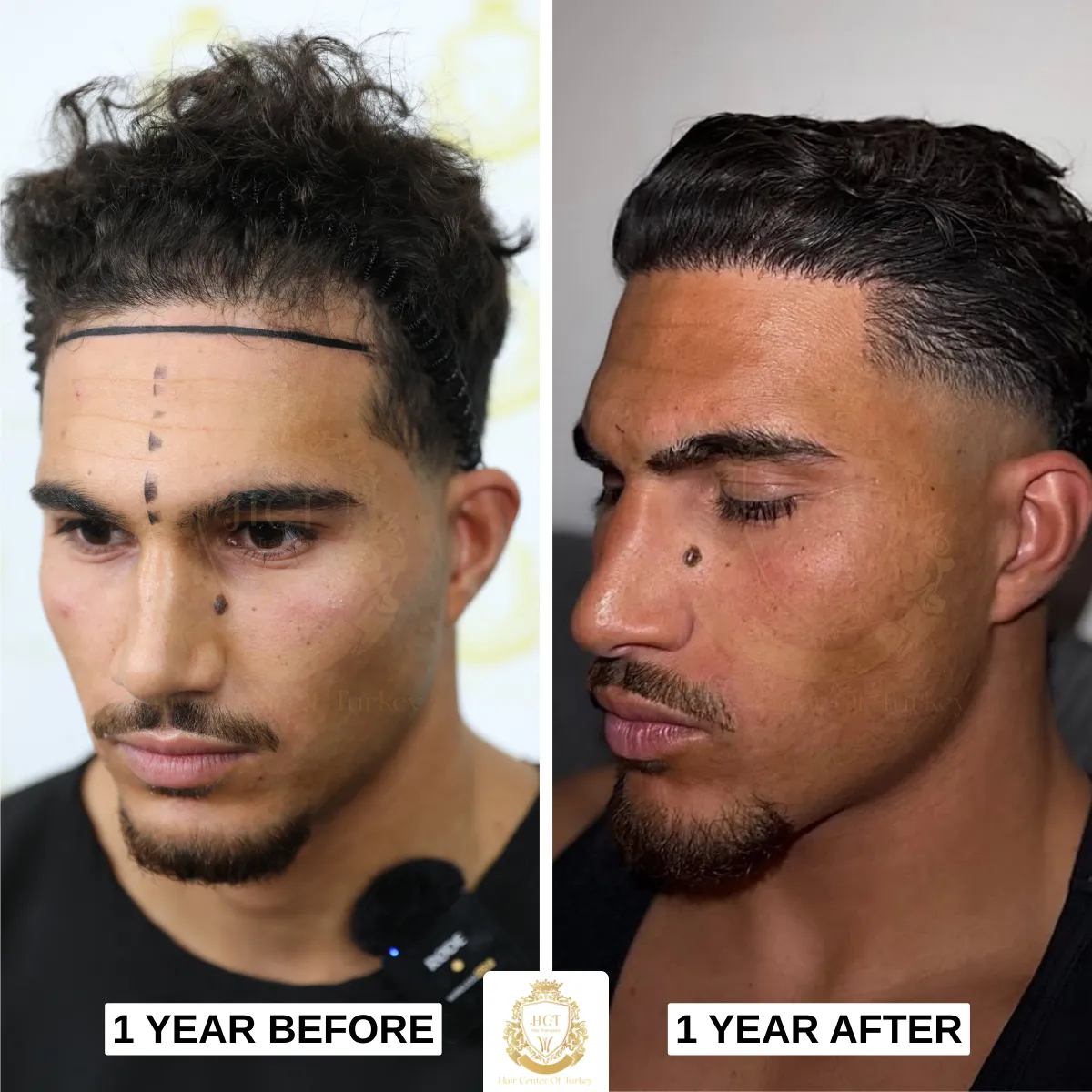 1 year hair transplant before after hair transplant recovery process
