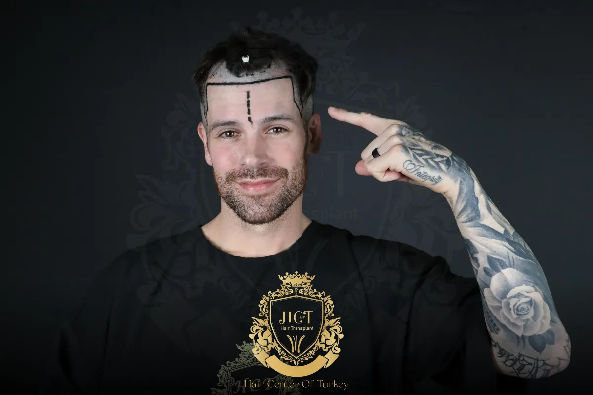 receding hairline
