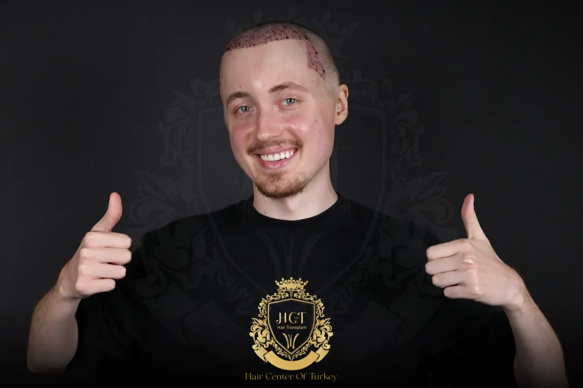 receding hairline