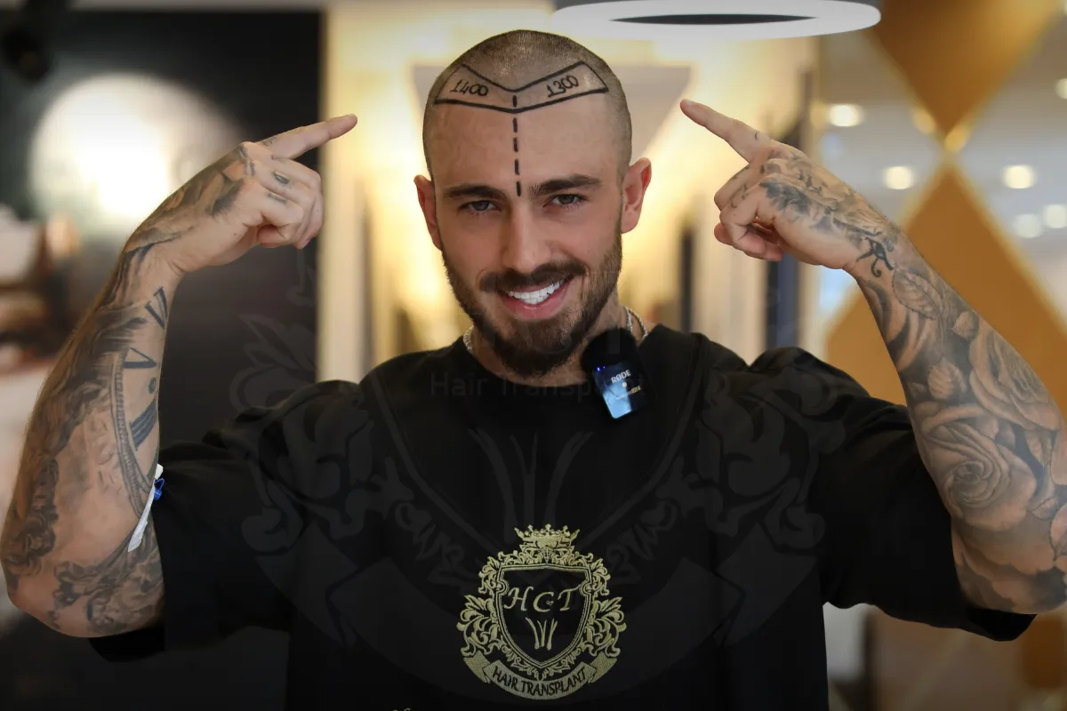 receding hairline