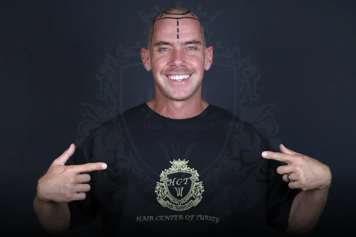 receding hairline