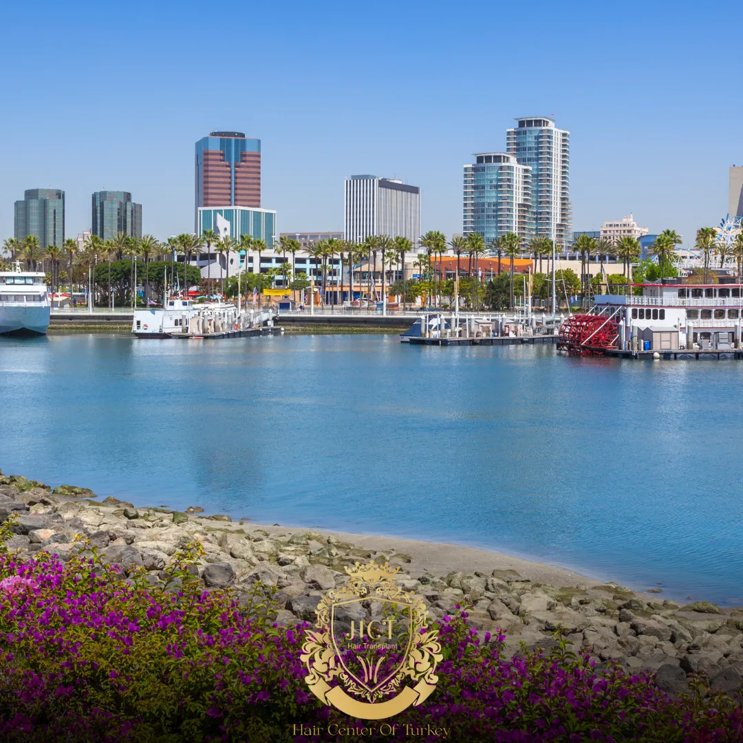 What Are the Best Hair Transplant Clinics in Long Beach F