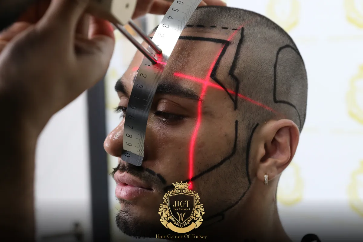 receding hairline