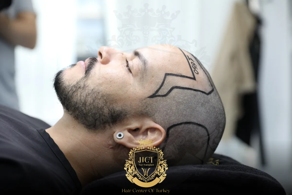 receding hairline