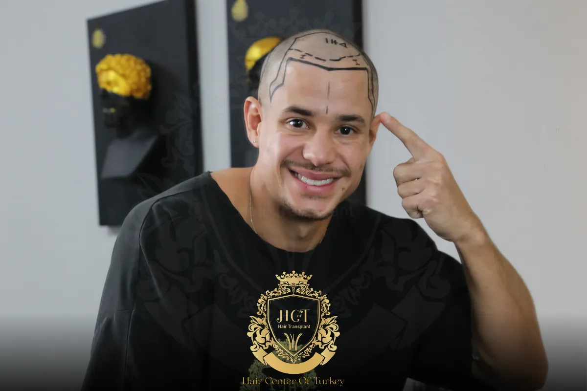 receding hairline