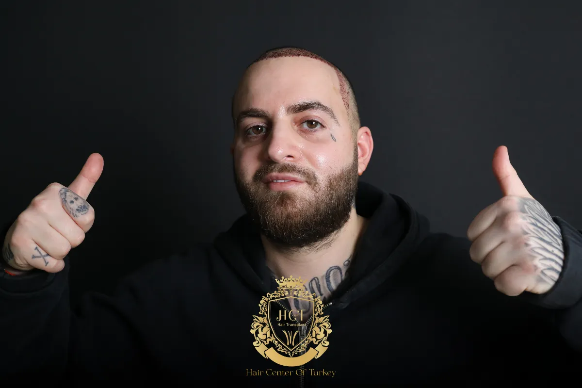 receding hairline