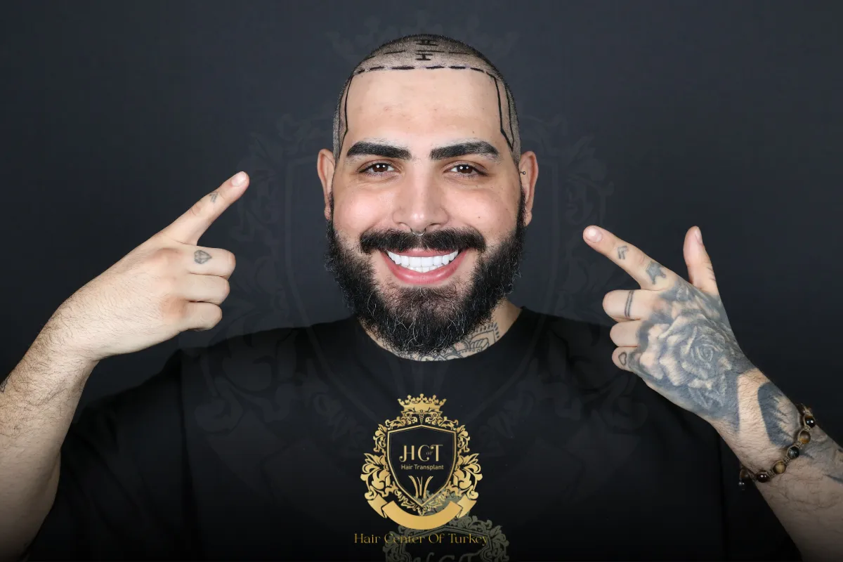receding hairline