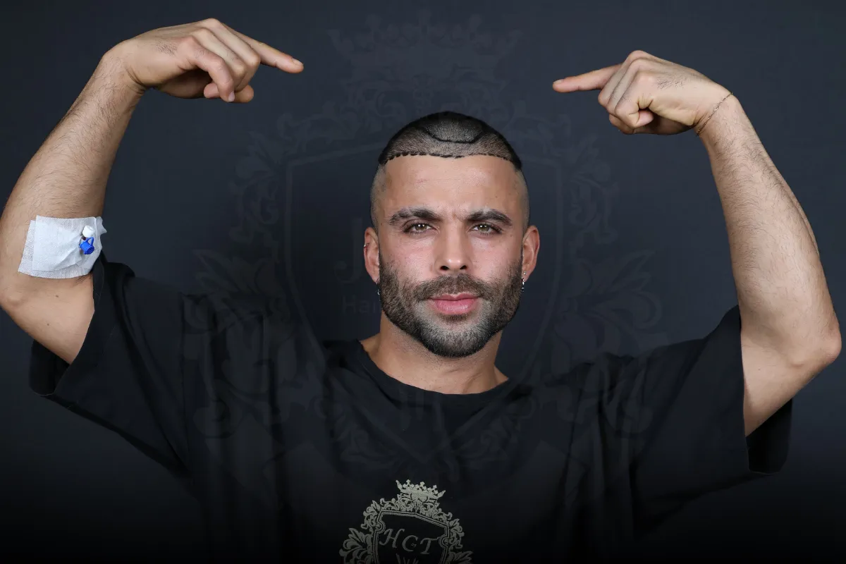 receding hairline