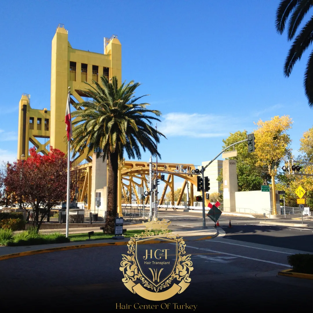 What Are the Best Hair Transplant Clinics in Sacramento F
