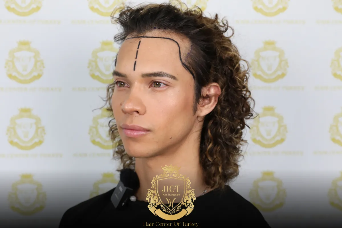 receding hairline
