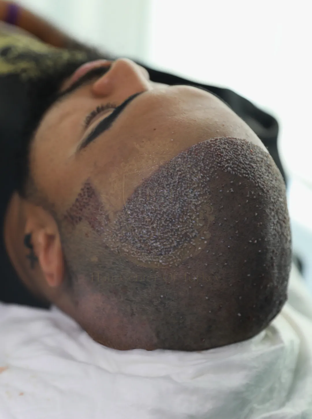 transplante capilar afro turquia hair center of turkey clínica