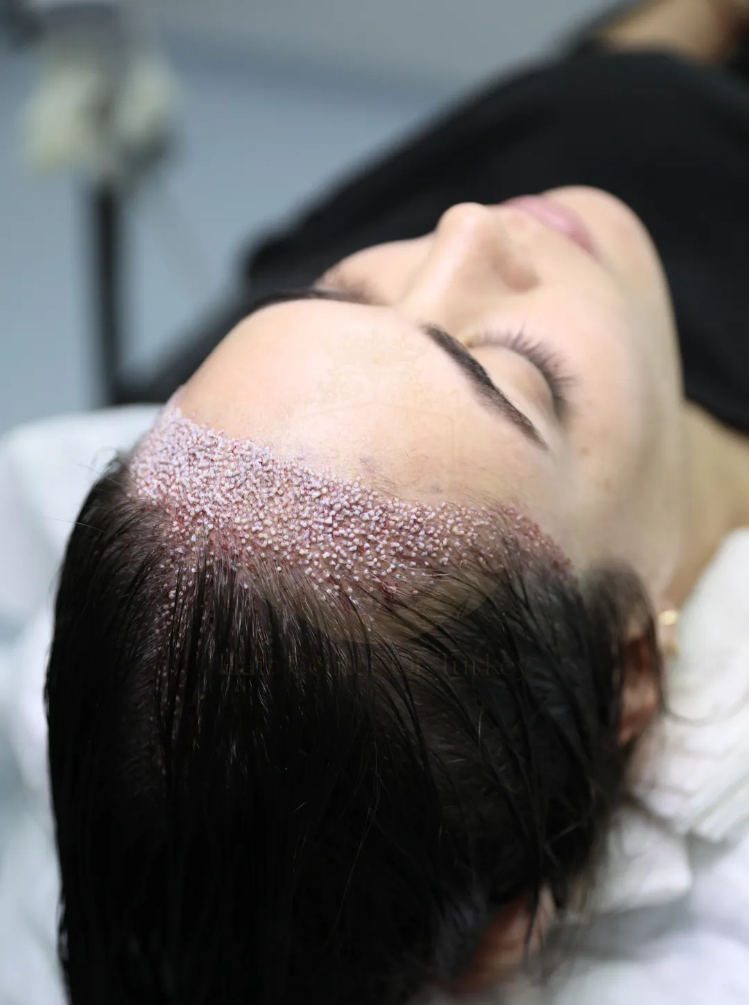 transplante capilar feminino turquia hair center of turkey clínica