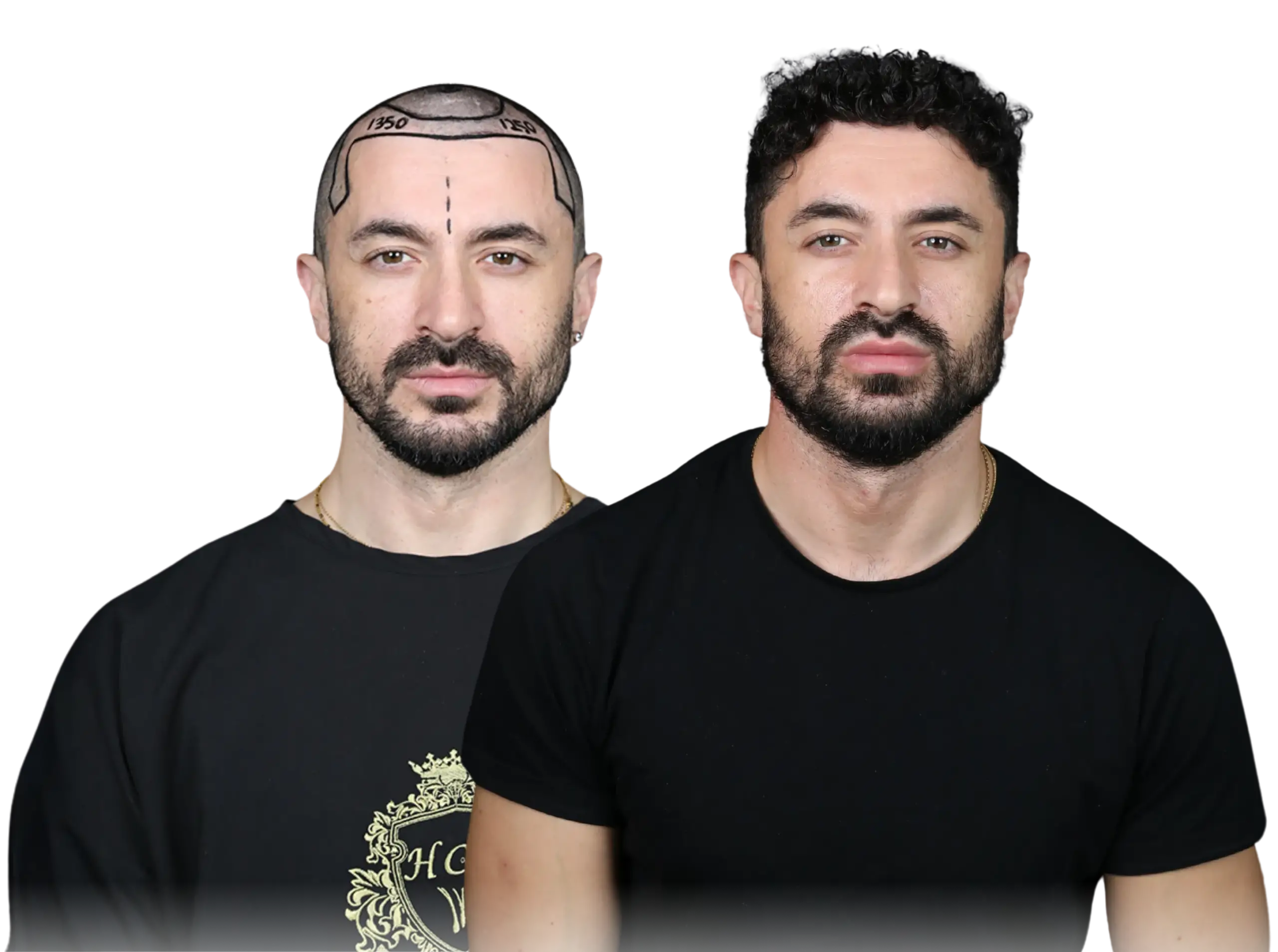 hair transplant before and after