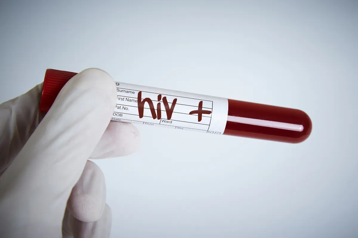 hiv hair transplant in turkey