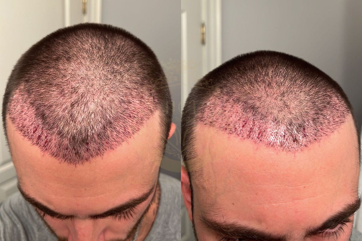 10 day hair transplant recovery process