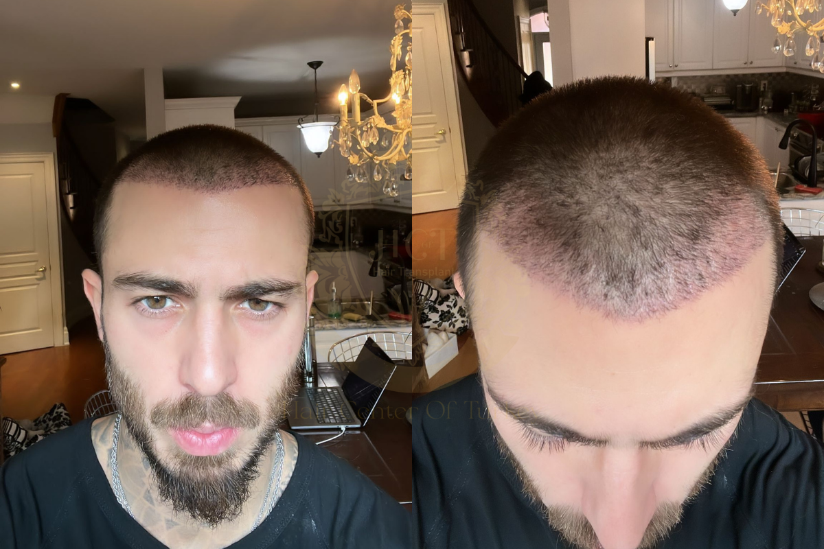 20 day hair transplant recovery process