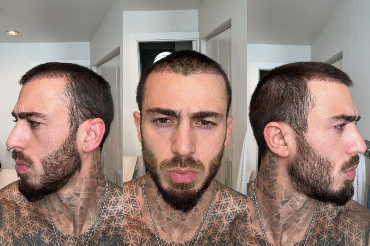 3 month hair transplant recovery process