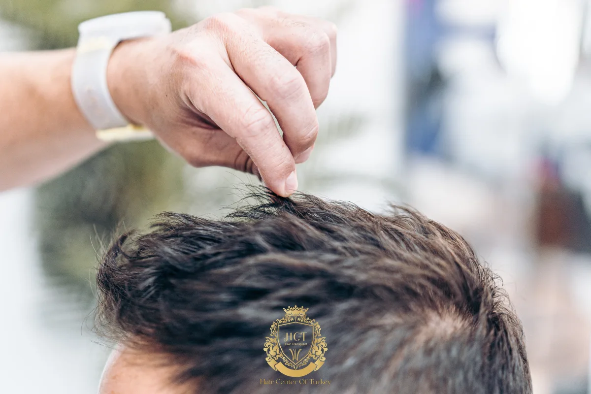 receding hairline
