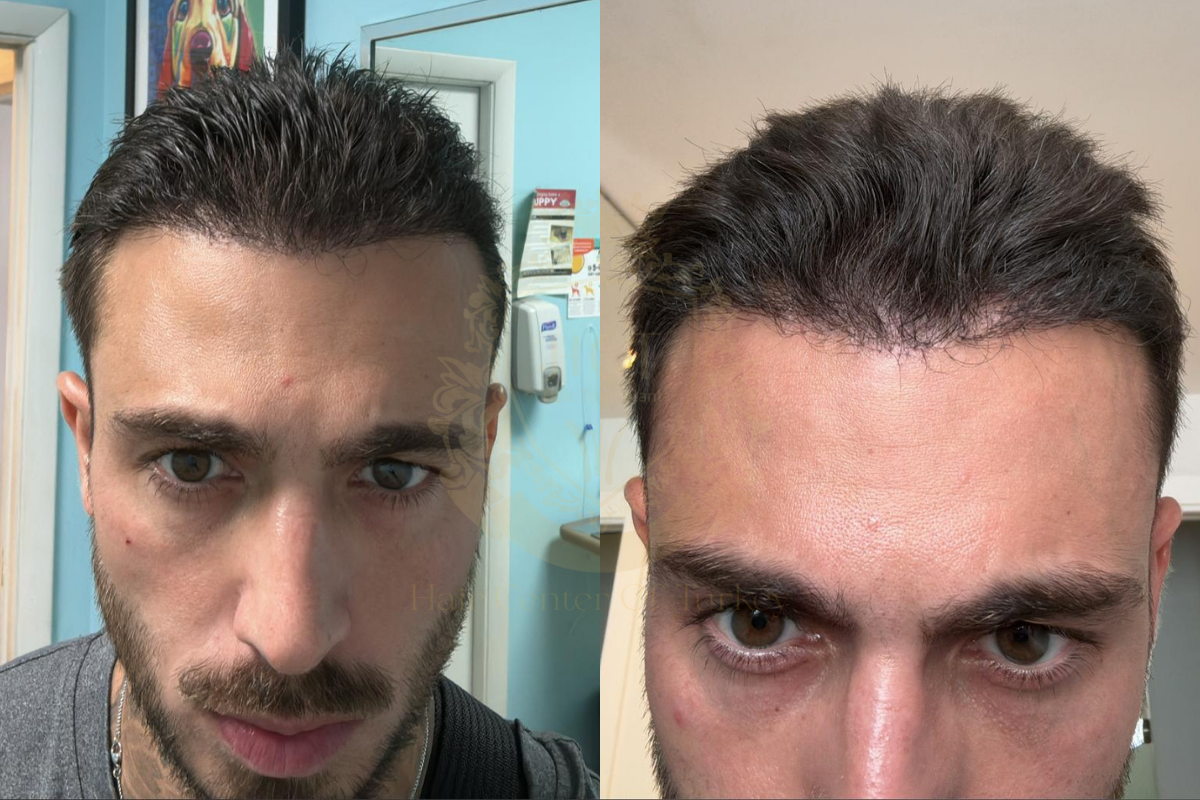6 month hair transplant recovery process