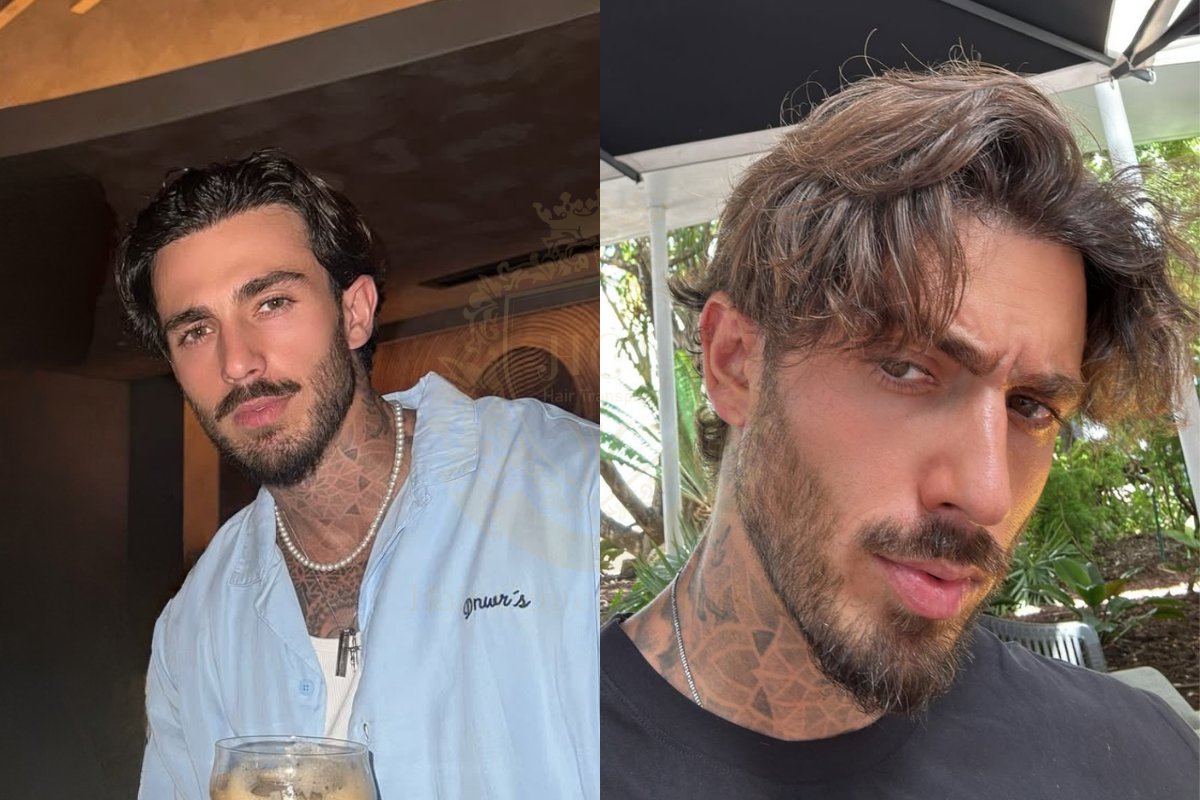 9-12 month hair transplant recovery process