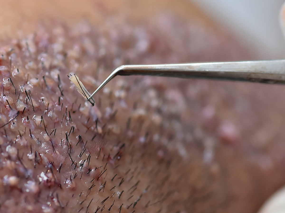 best hair transplant clinic in turkey