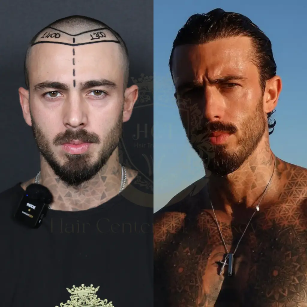 matia marcantuoni patient story hair transplant before and after
