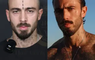 matia marcantuoni patient story hair transplant before and after