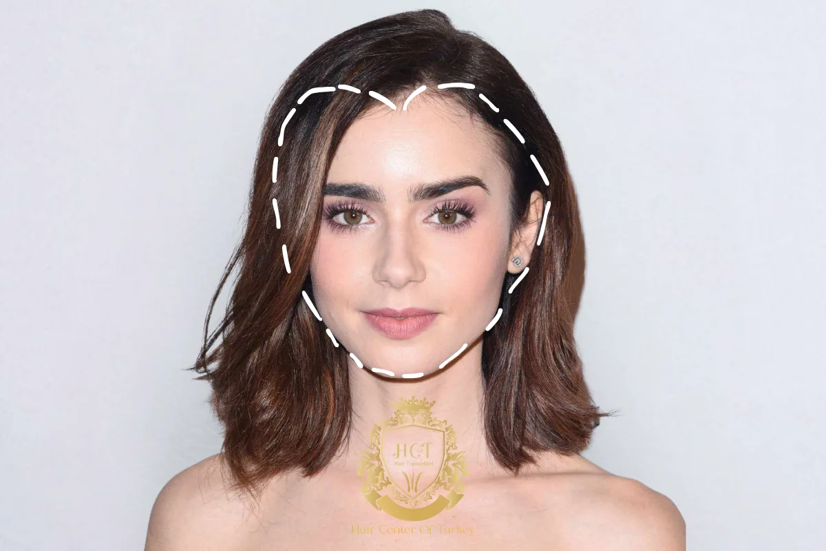 2_result receding hairline