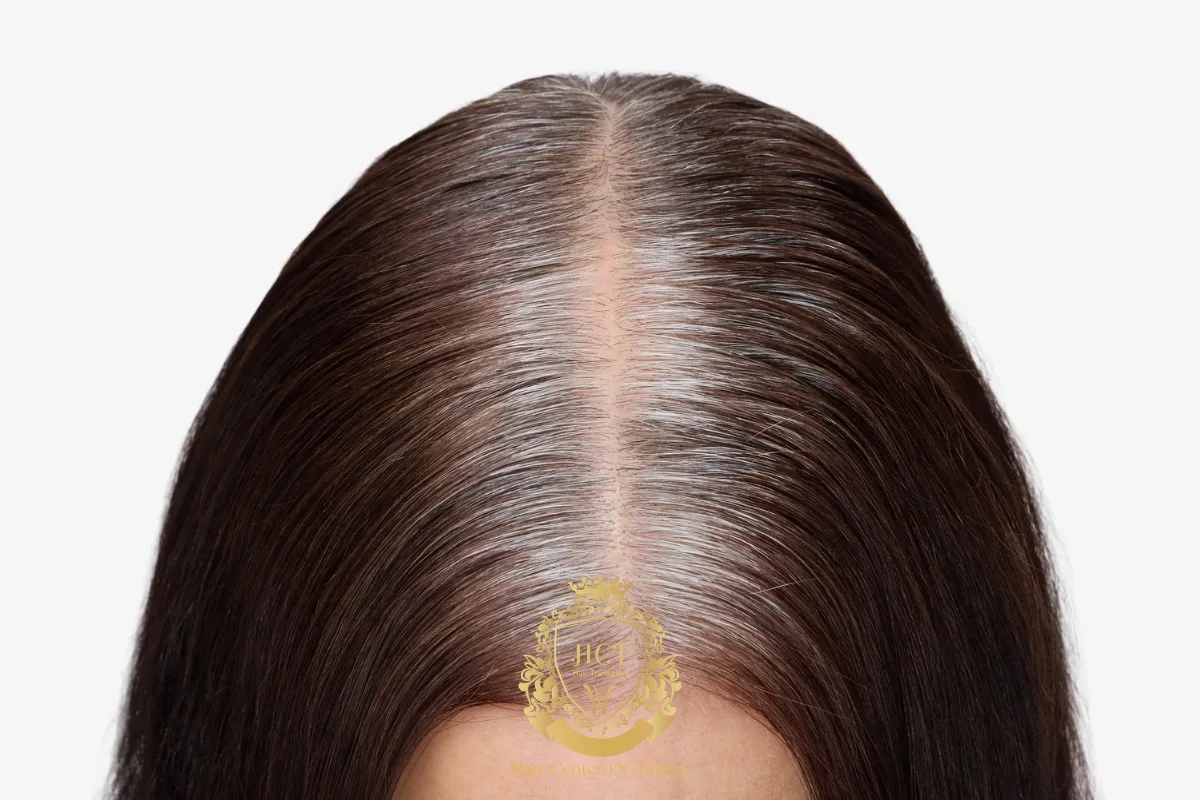 3_result receding hairline