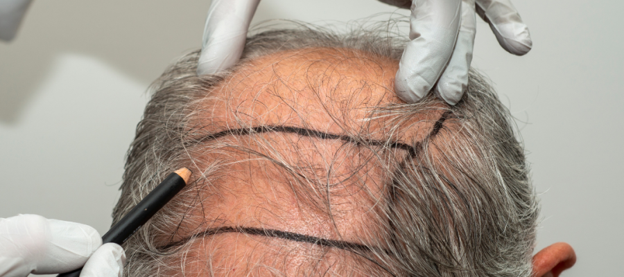 Pessoas idosas podem fazer transplante capilar?