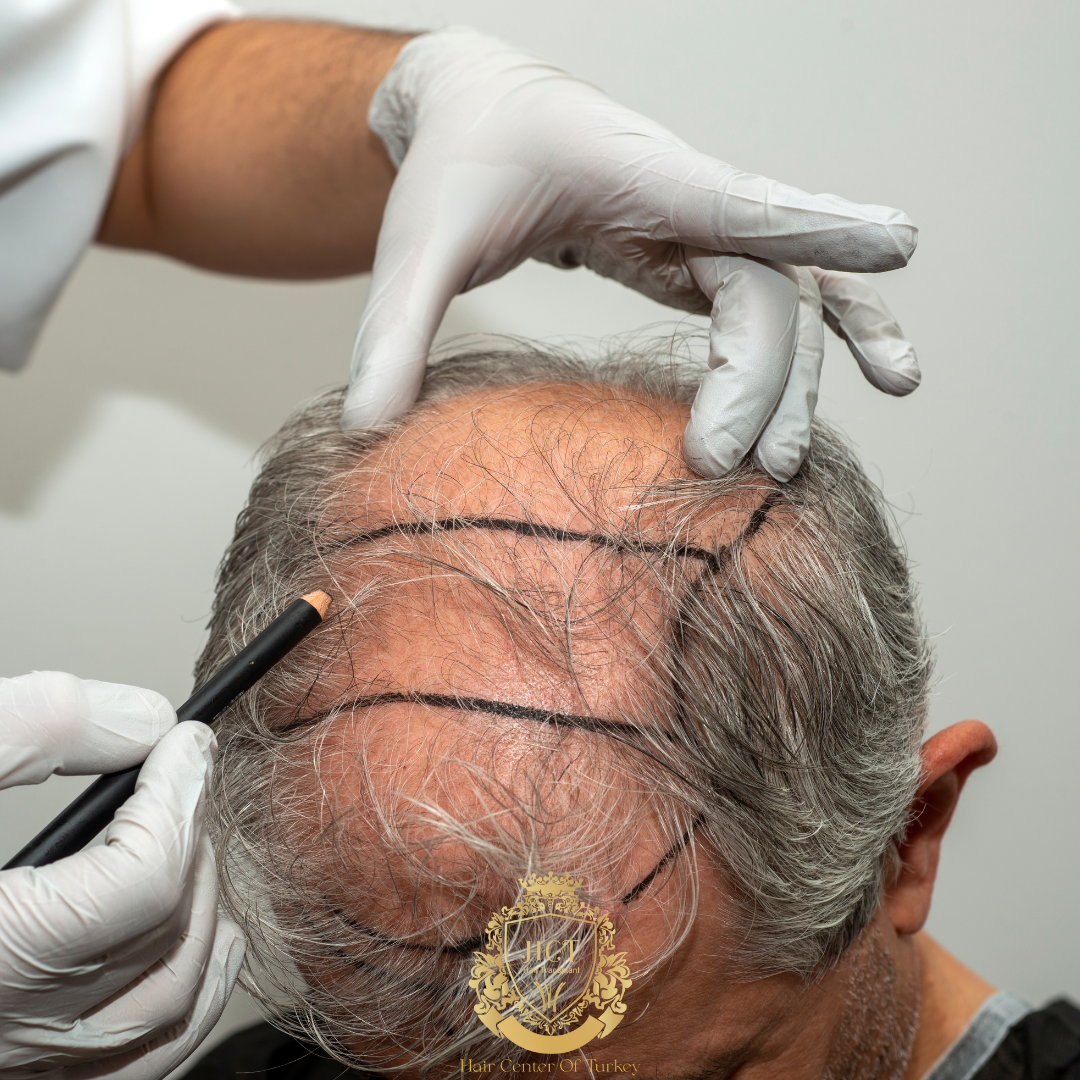 Pessoas idosas podem fazer transplante capilar?