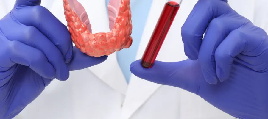 Pueden las personas con problemas de tiroides recibir un trasplante capilar