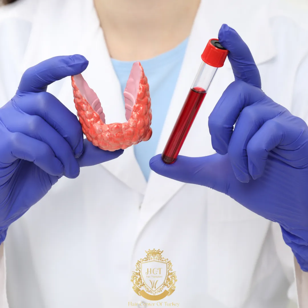 ¿Pueden las personas con problemas de tiroides recibir un trasplante capilar? 1 Pueden las personas con problemas de tiroides recibir un trasplante capilar