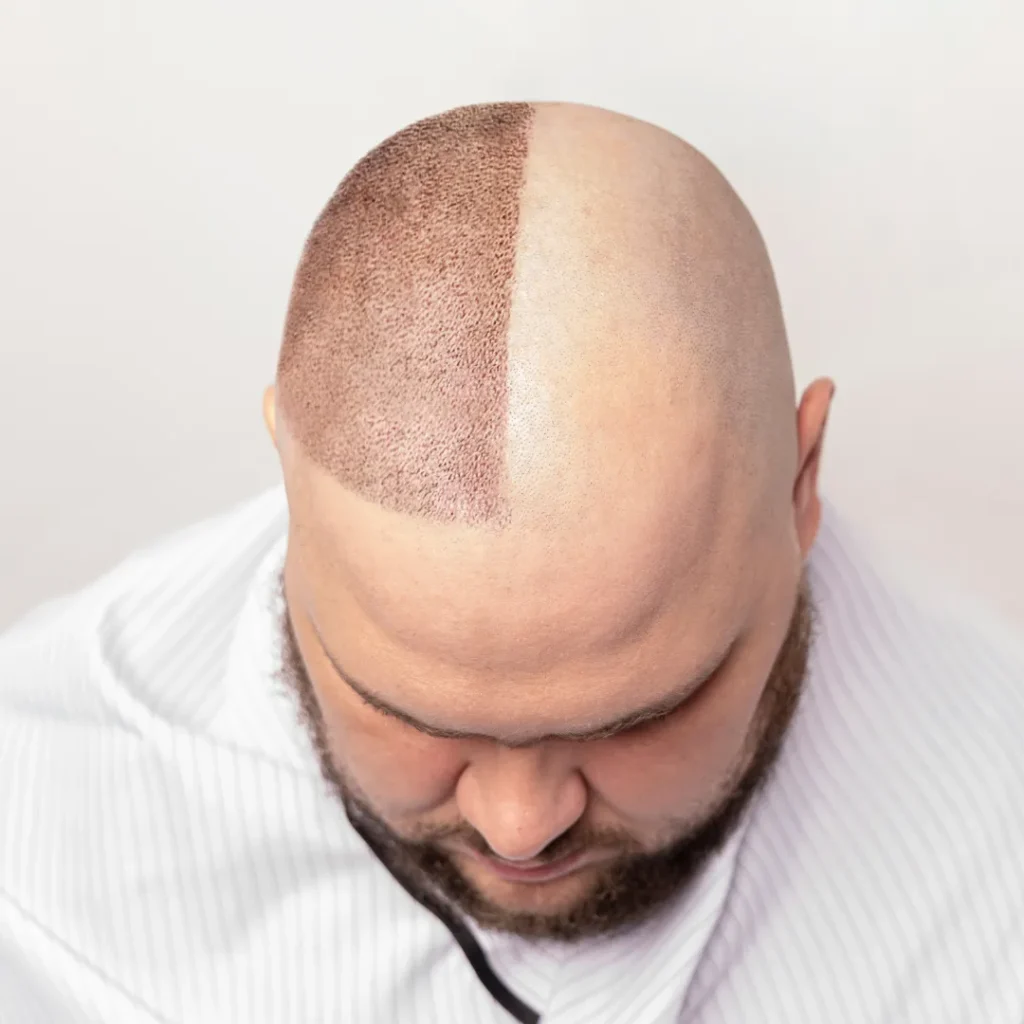 Wat gebeurt er als een haartransplantatie mislukt?