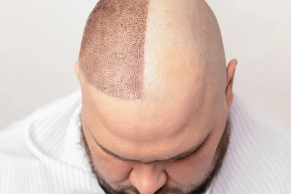 What Happens When a Hair Transplant Fails?