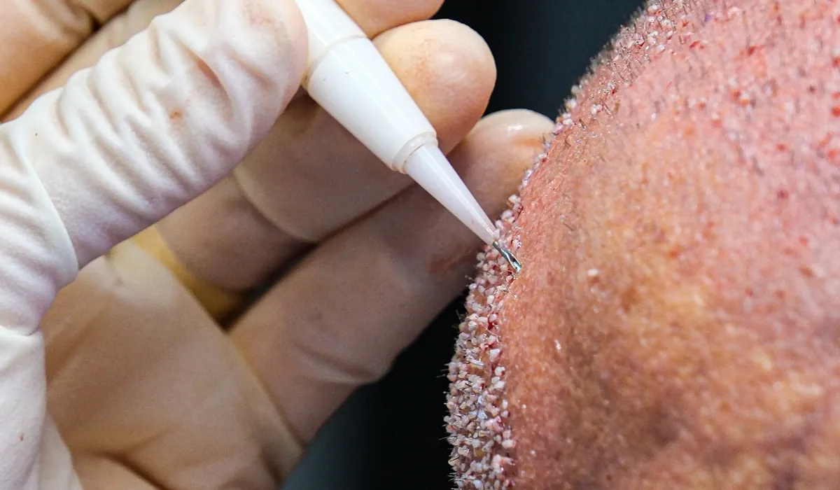 Antonio-Conte-Haartransplantatie-6 Antonio-Conte-Haartransplantatie-6