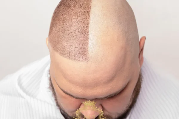 Lohnen sich Haartransplantationen oder bereuen es die Menschen?