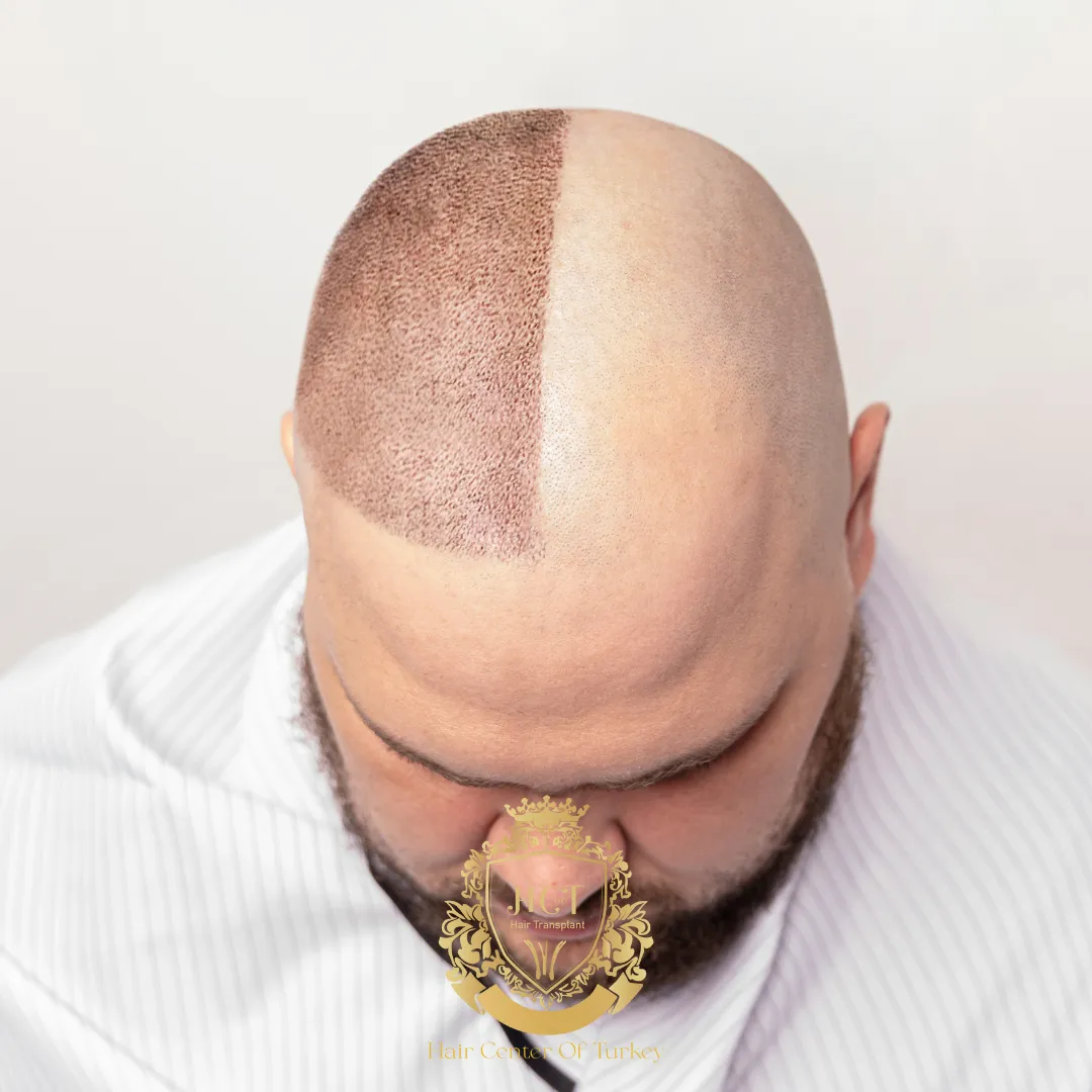 Saç Ekimi Buna Değer mi, Yoksa İnsanlar Pişman mı Oluyor?