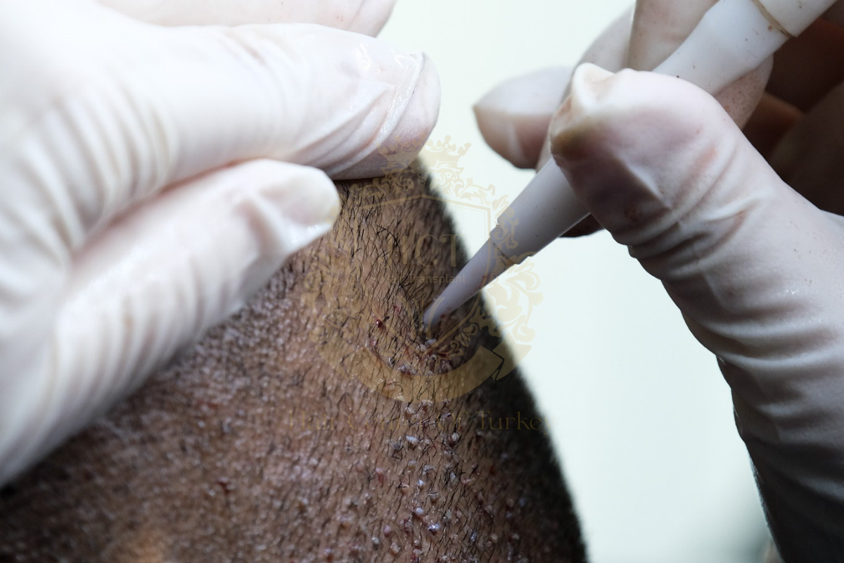 Are hair transplants safer or more advanced receding hairline