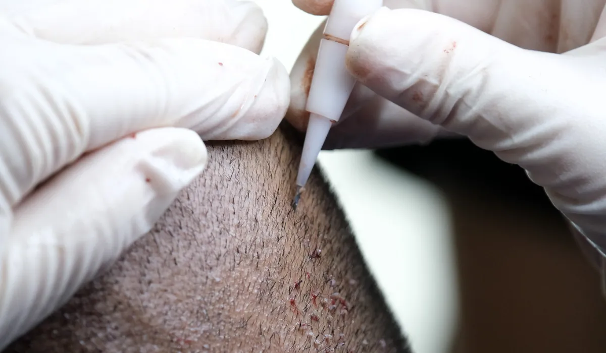 Calum – Beste haartransplantatie – 6 Calum Best Hair Transplant 6