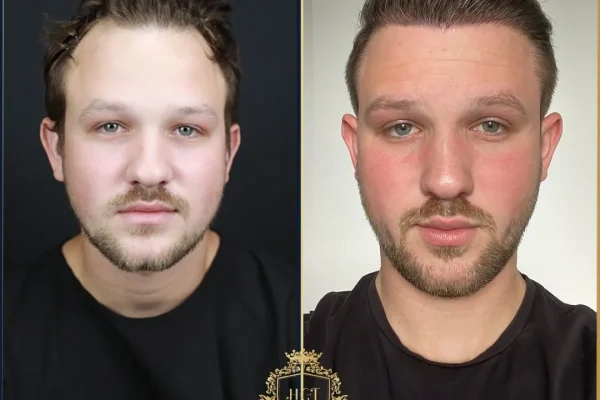 Can Diabetic Patients Get Hair Transplants?