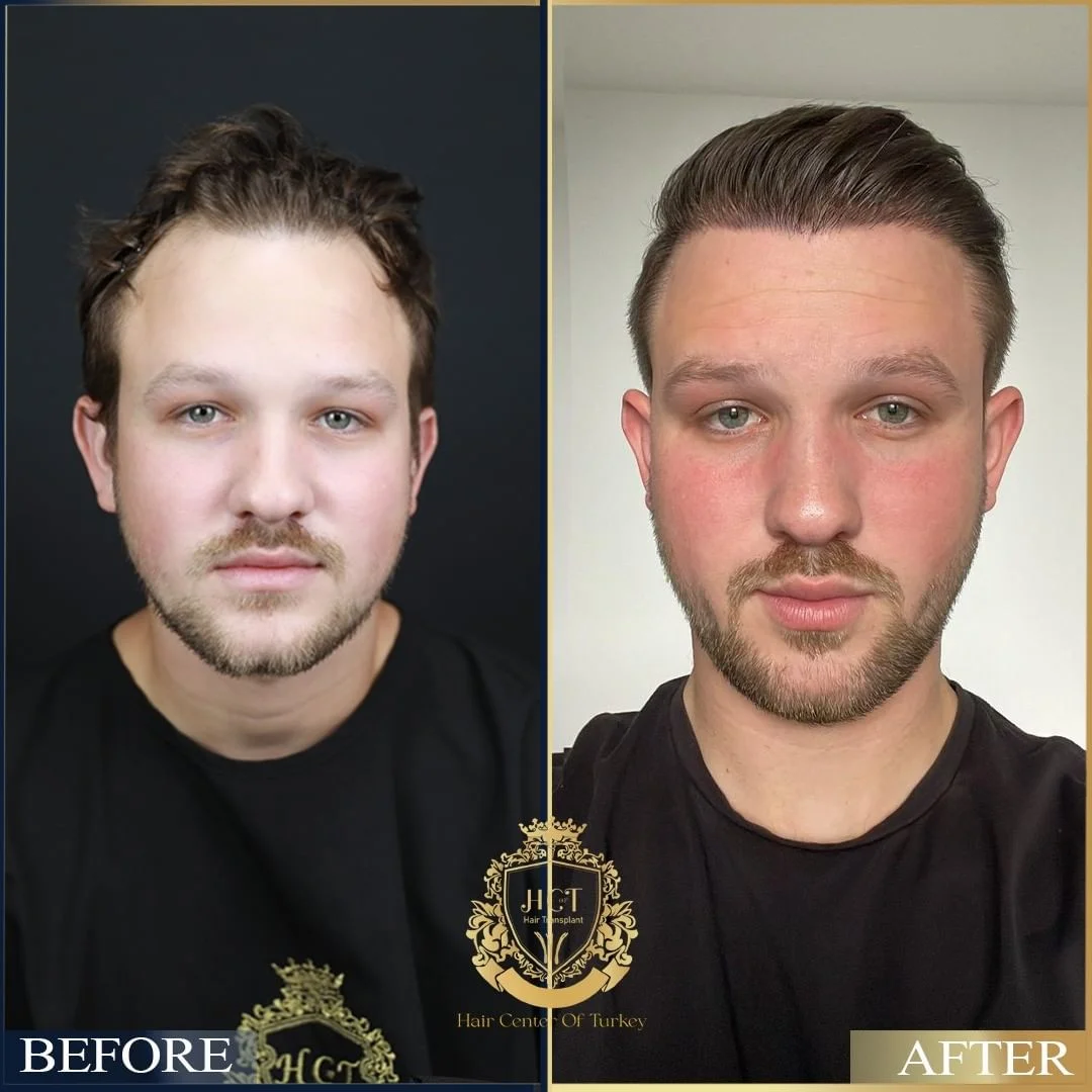 Trasplante capilar antes y después