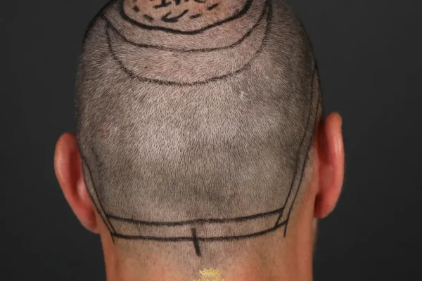 Können Haare vom Körper zum Kopf Transplantiert Werden?