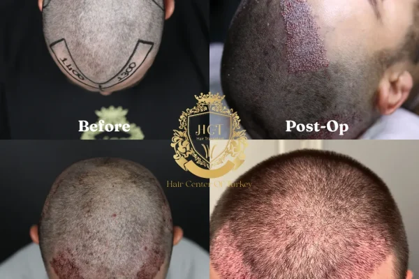 Kann ich nach einer Haartransplantation wieder arbeiten gehen?