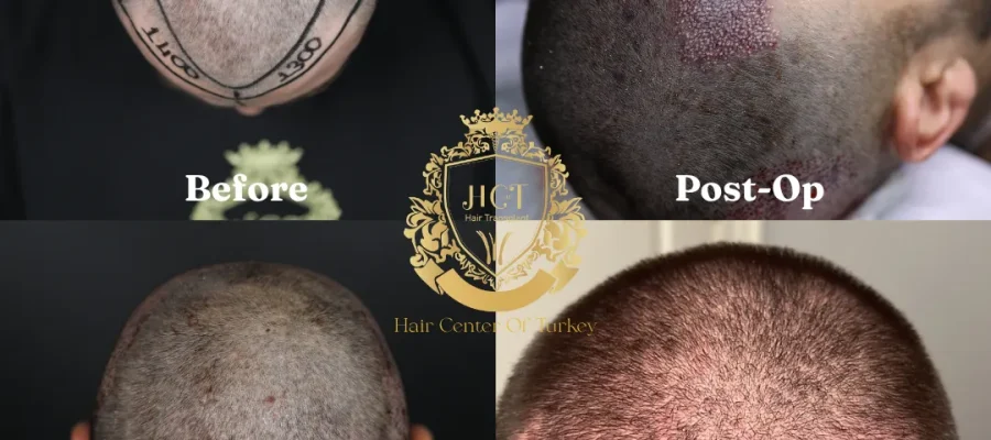 ¿Puedo volver a trabajar después de un trasplante capilar?