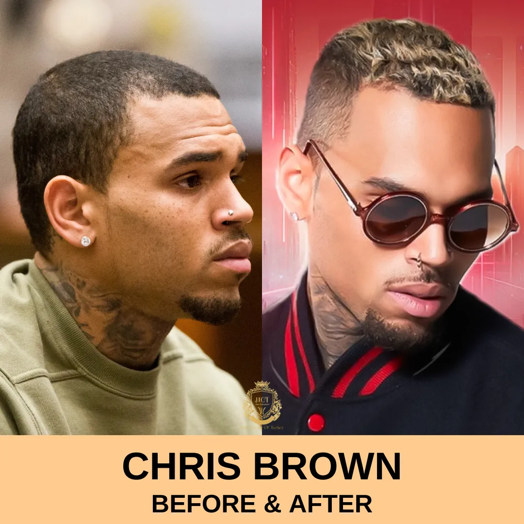 Transplante capilar de Chris Brown