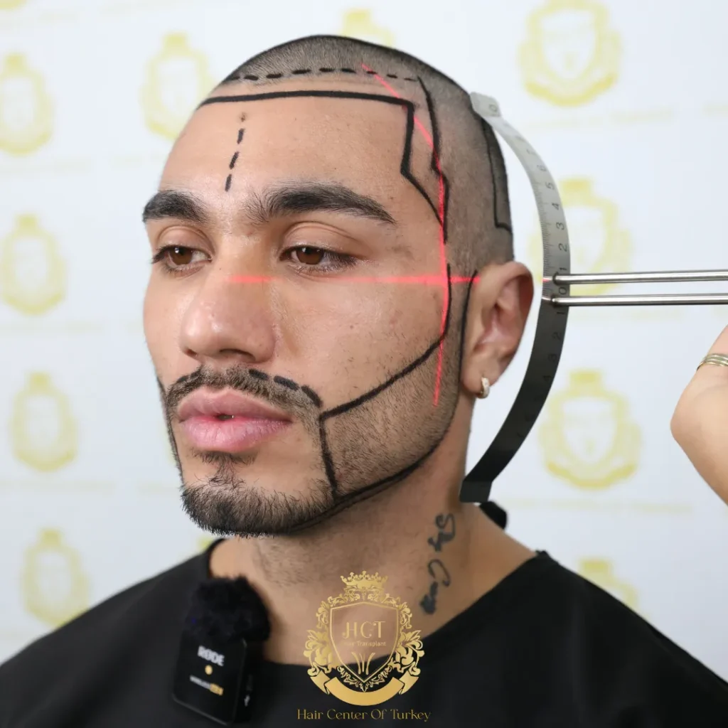 Vergleich von DHI und FUE bei der Barttransplantation